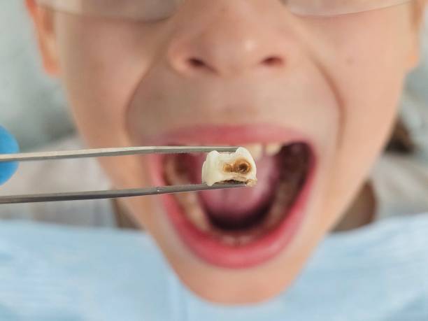Best Emergency Treatment for Dental Infections or Abscesses in Birchwood Lakes, PA
